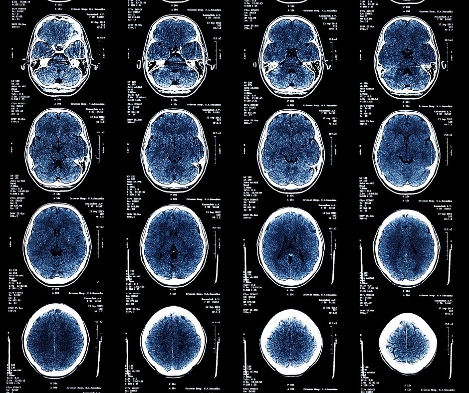 Traumatic Brain Injury MRI Scans